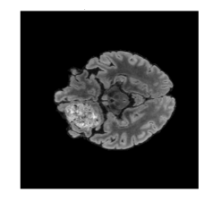 MRI brain scan used for tumor segmentation